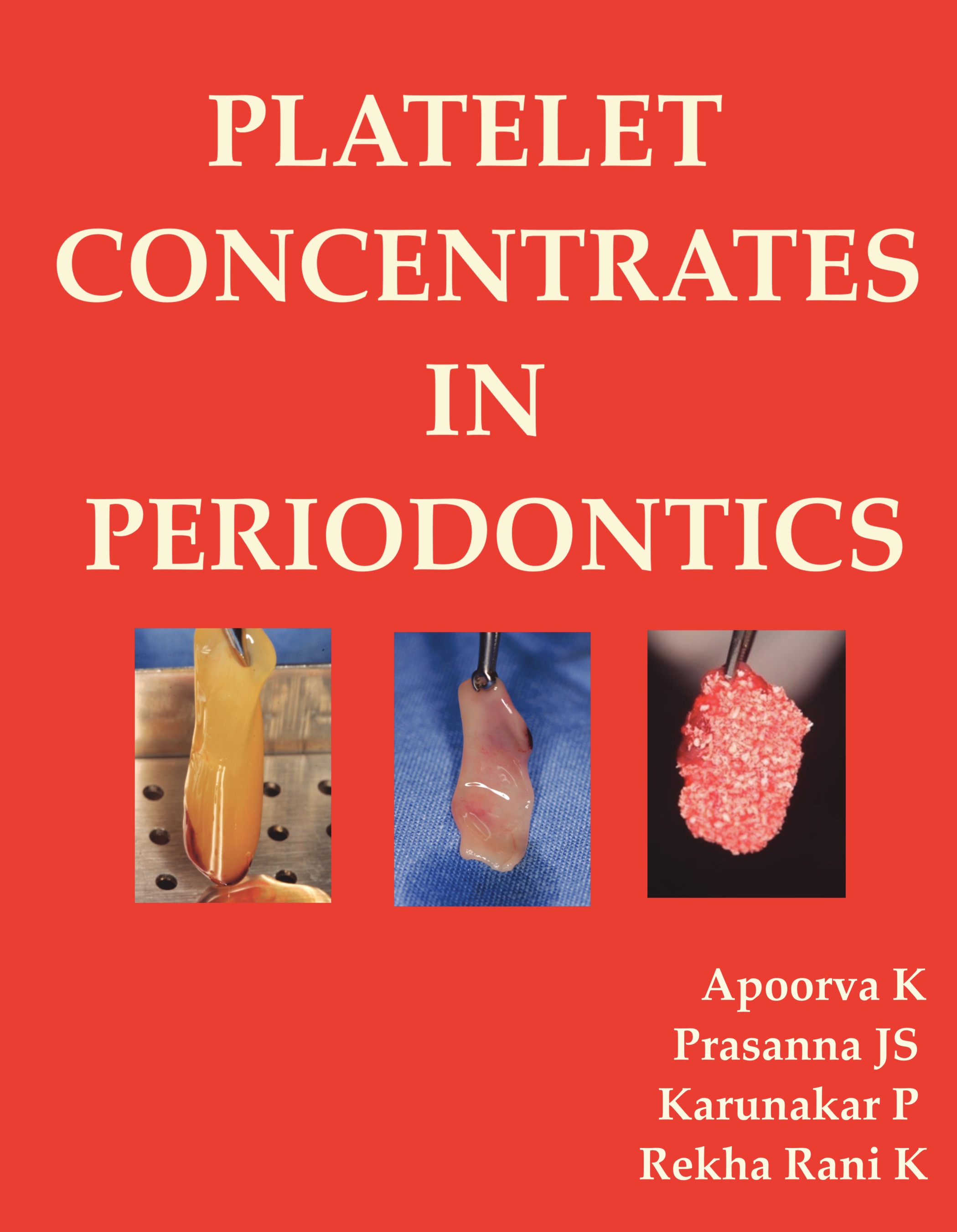 Platelet Concentrates In Periodontics Pothi Com